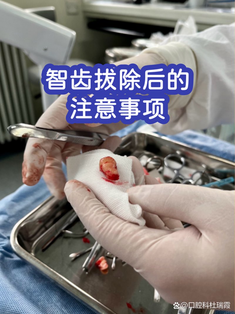 智齿拔除